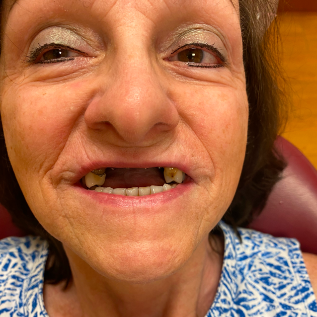 whitening before.